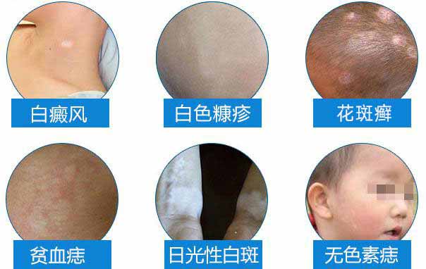 脸上白癜风如何治疗有效