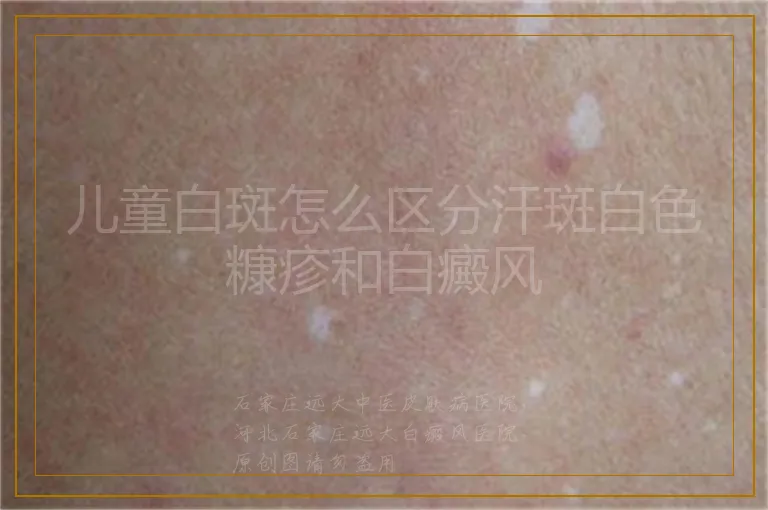 儿童白斑怎么区分汗斑白色糠疹和白癜风