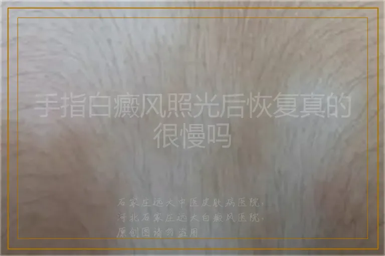 手指白癜风照光后恢复真的很慢吗