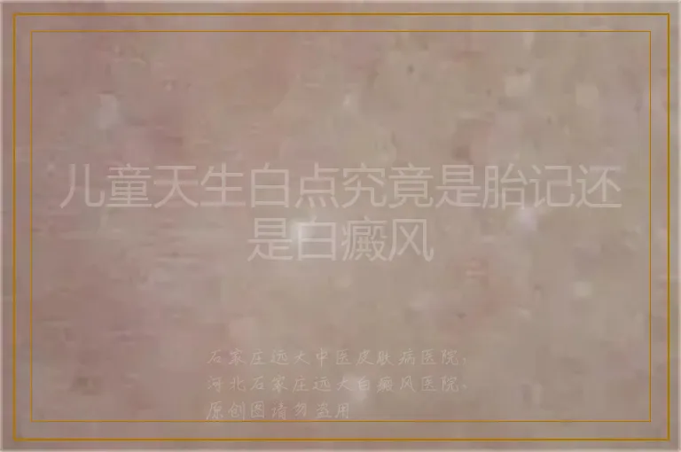 儿童天生白点究竟是胎记还是白癜风