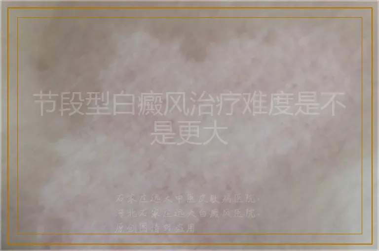 节段型白癜风治疗难度是不是更大