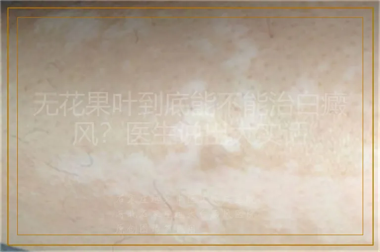 无花果叶到底能不能治白癜风？医生说出大实话
