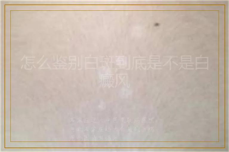怎么鉴别白斑到底是不是白癜风