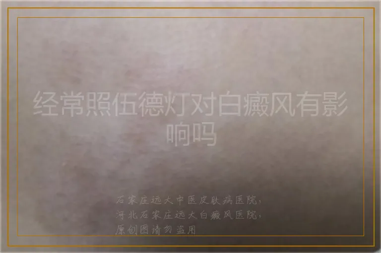 经常照伍德灯对白癜风有影响吗