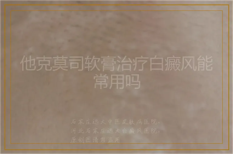 他克莫司软膏治疗白癜风能常用吗