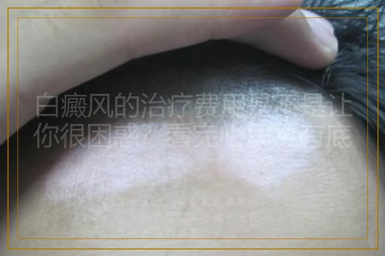 白癜风的治疗费用是不是让你很困惑?看完心里更有底