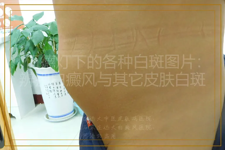 伍德灯下的各种白斑图片:辨别白癜风与其它皮肤白斑