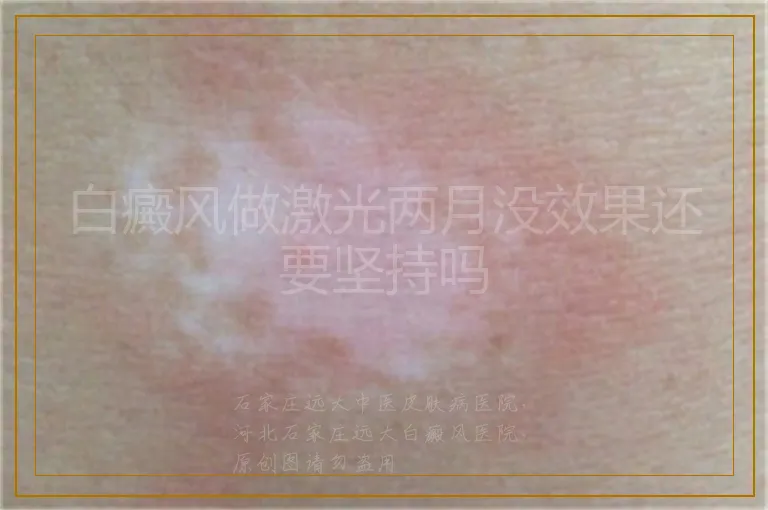 白癜风做激光两月没效果还要坚持吗