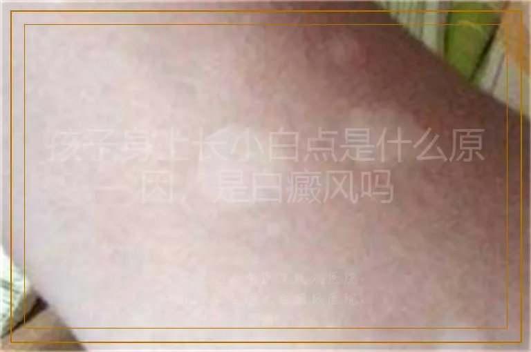 孩子身上长小白点是什么原因，是白癜风吗