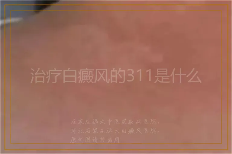 治疗白癜风的311是什么