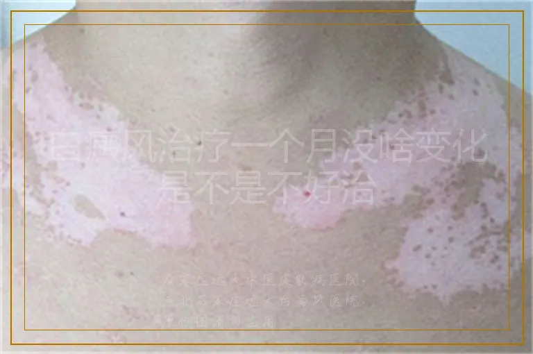 白癜风治疗一个月没啥变化是不是不好治