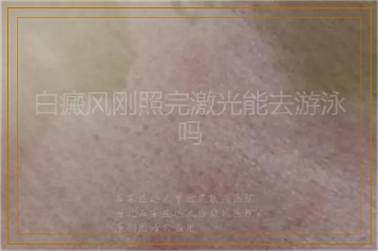 白癜风刚照完激光能去游泳吗