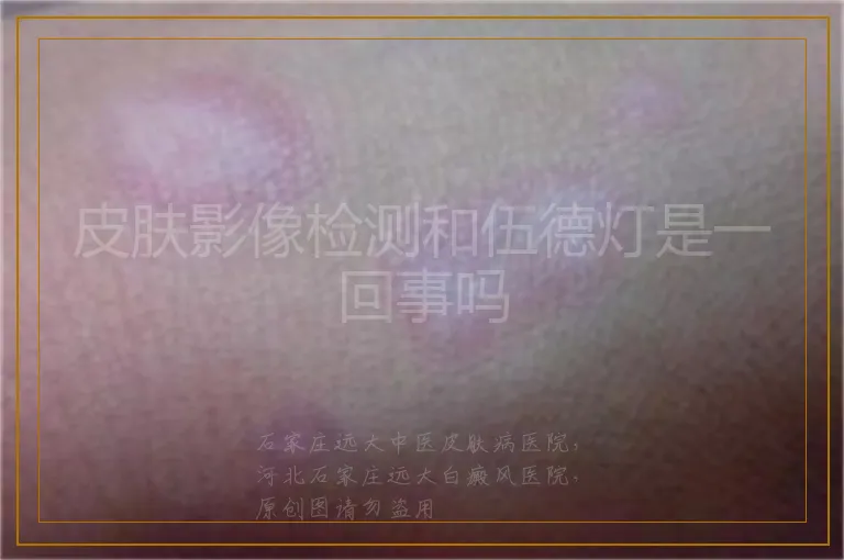 皮肤影像检测和伍德灯是一回事吗