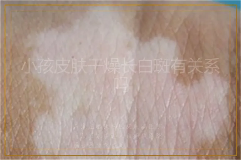 小孩皮肤干燥长白斑有关系吗