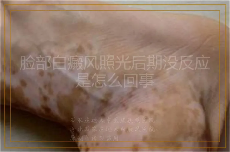 脸部白癜风照光后期没反应是怎么回事