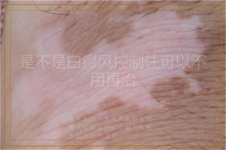 是不是白癜风控制住可以不用再治