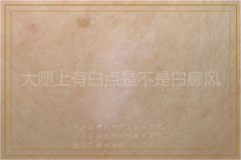 大腿上有白点是不是白癜风