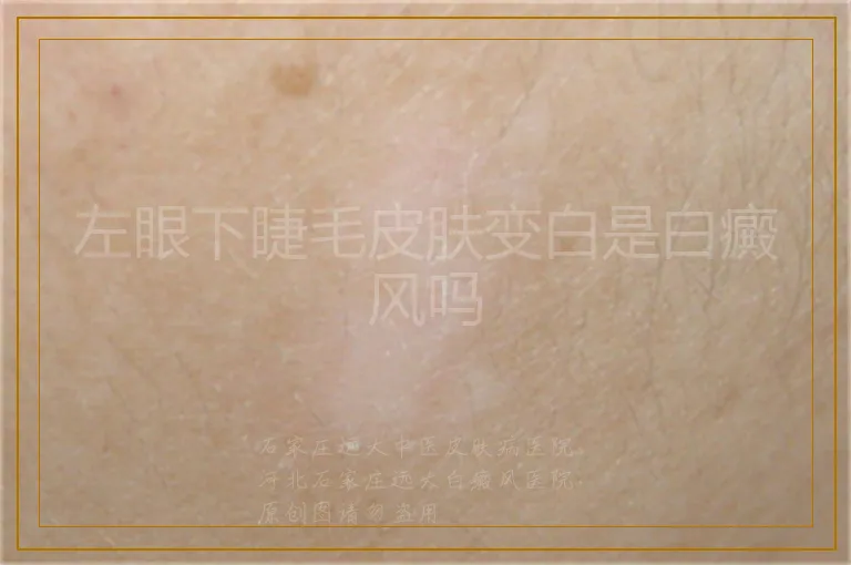 左眼下睫毛皮肤变白是白癜风吗