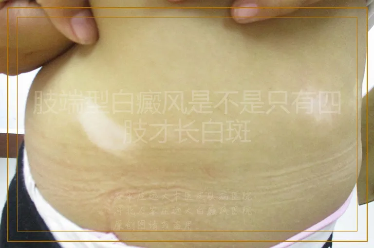 肢端型白癜风是不是只有四肢才长白斑