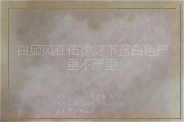 白癜风在伍德灯下蓝白色严重不严重