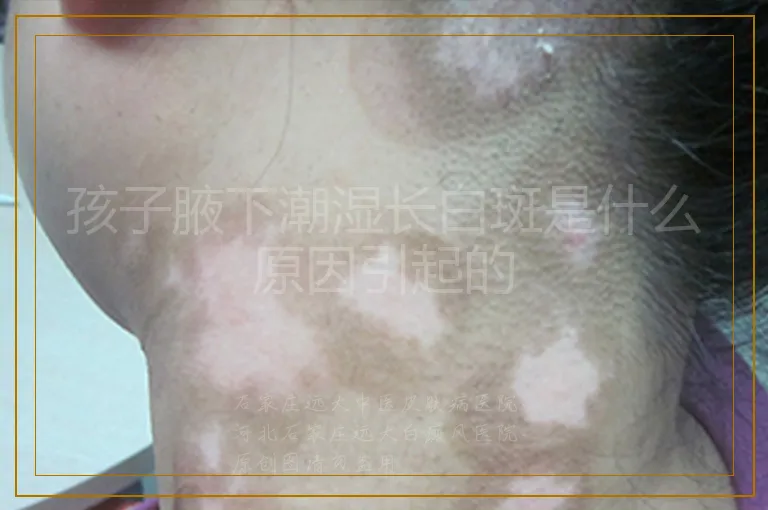 孩子腋下潮湿长白斑是什么原因引起的