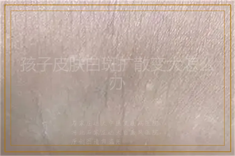 孩子皮肤白斑扩散变大怎么办