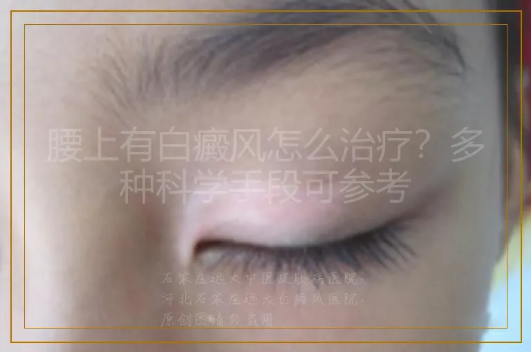 腰上有白癜风怎么治疗？多种科学手段可参考