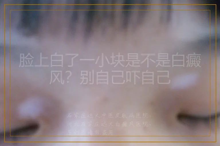 脸上白了一小块是不是白癜风?别自己吓自己