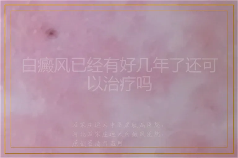 白癜风已经有好几年了还可以治疗吗