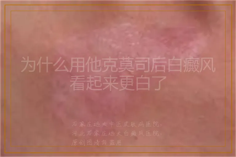 为什么用他克莫司后白癜风看起来更白了