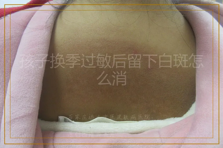 孩子换季过敏后留下白斑怎么消