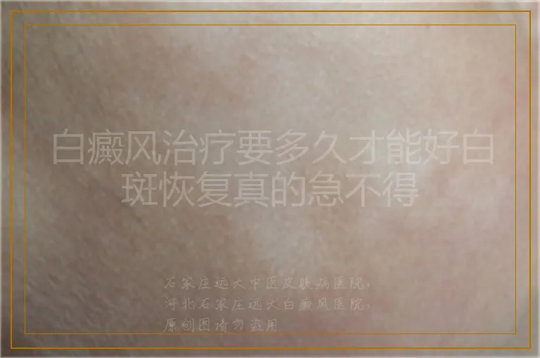 白癜风治疗要多久才能好白斑恢复真的急不得