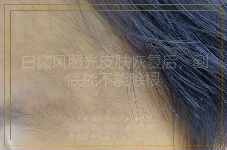 白癜风照光皮肤恢复后,到底能不能除根