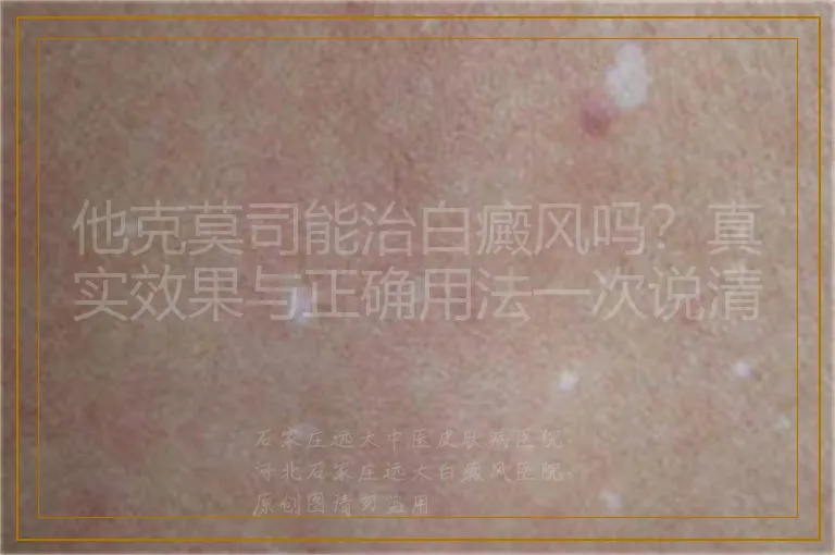他克莫司能治白癜风吗?真实效果与正确用法一次说清