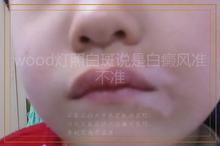 wood灯照白斑说是白癜风准不准