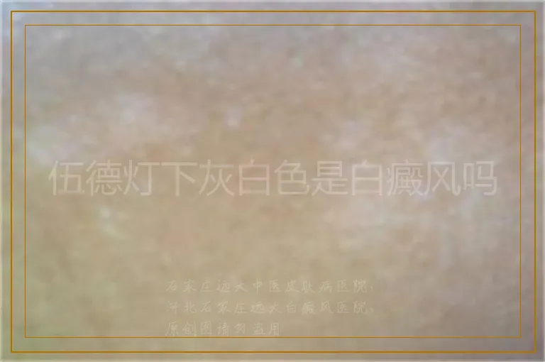 伍德灯下灰白色是白癜风吗