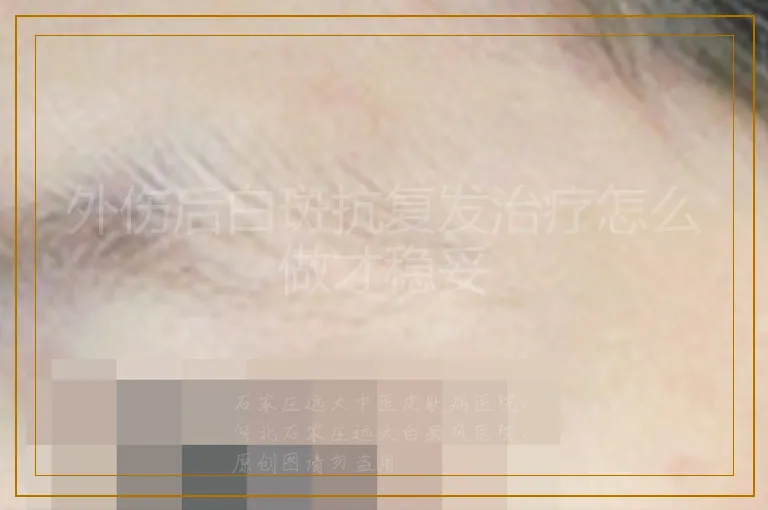 外伤后白斑抗复发治疗怎么做才稳妥