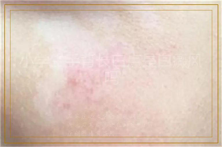 小学生手背长白点是白癜风吗