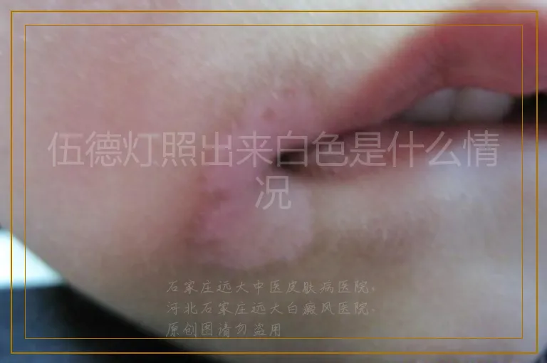 伍德灯照出来白色是什么情况