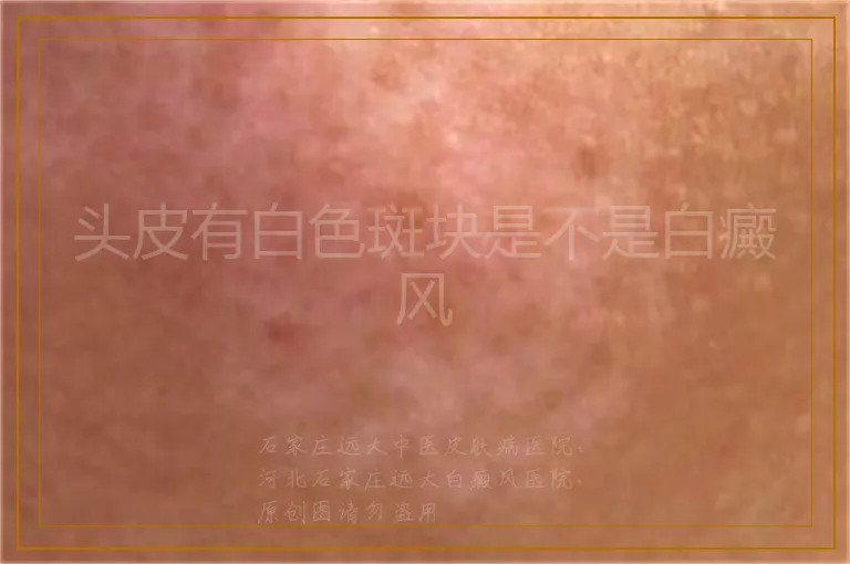 头皮有白色斑块是不是白癜风