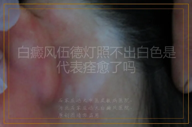 白癜风伍德灯照不出白色是代表痊愈了吗