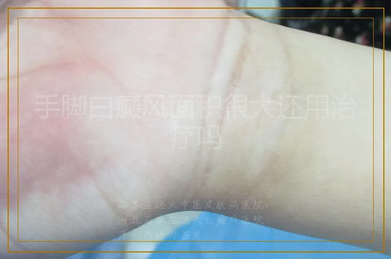 手脚白癜风面积很大还用治疗吗