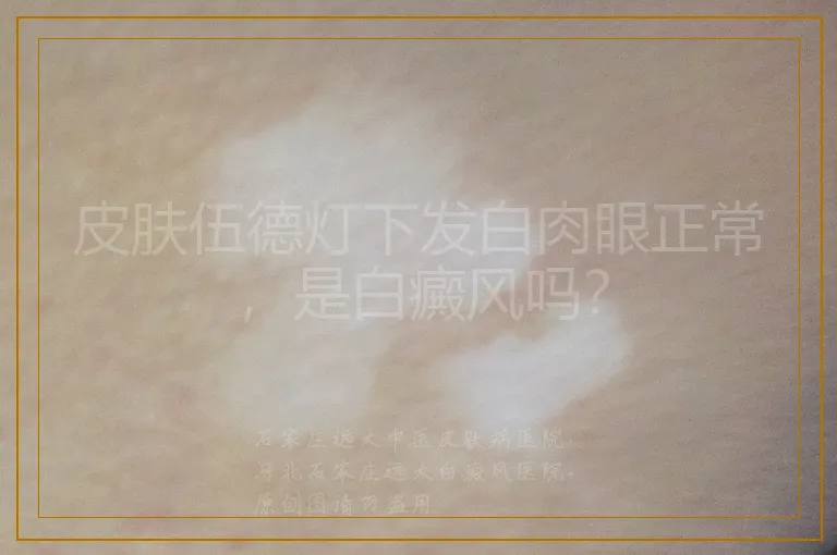 皮肤伍德灯下发白肉眼正常，是白癜风吗？