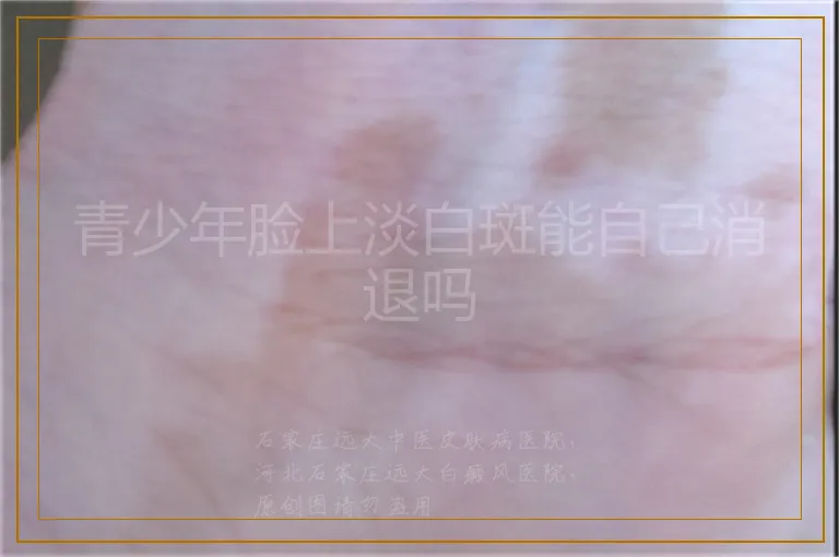 青少年脸上淡白斑能自己消退吗