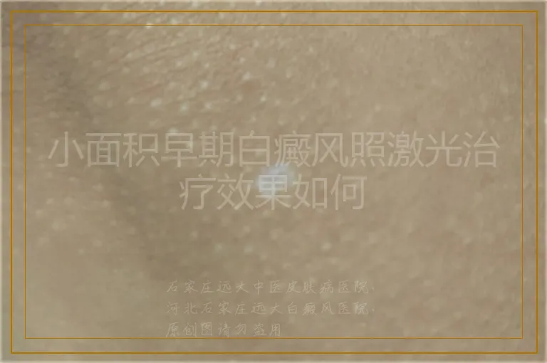 小面积早期白癜风照激光治疗效果如何