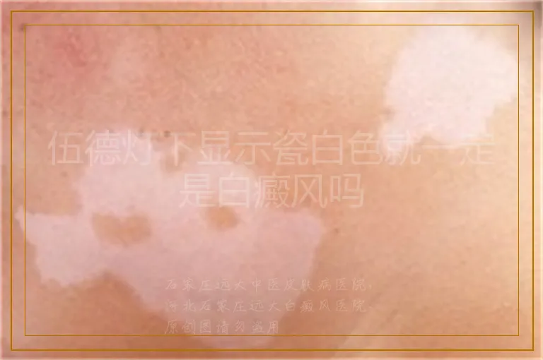 伍德灯下显示瓷白色就一定是白癜风吗
