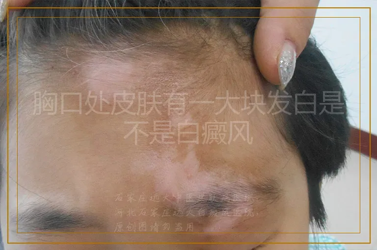 胸口处皮肤有一大块发白是不是白癜风