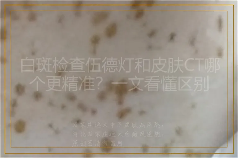 白斑检查伍德灯和皮肤CT哪个更精准？一文看懂区别
