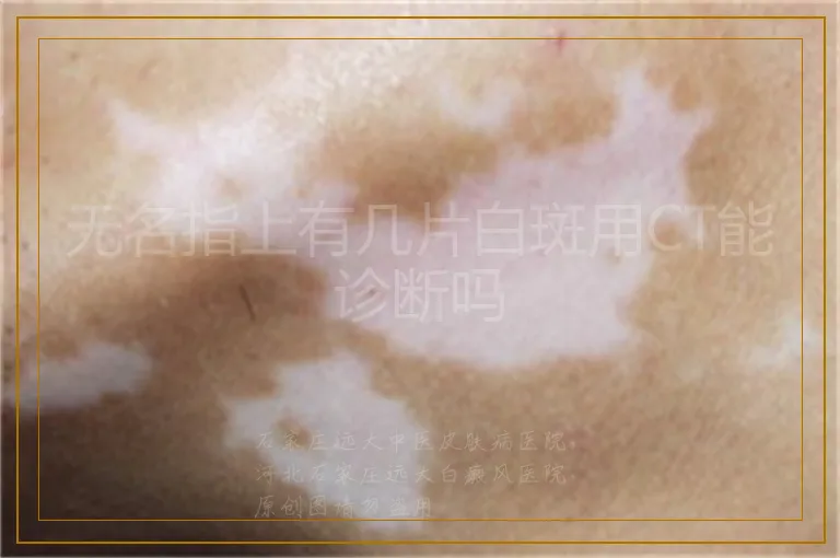无名指上有几片白斑用CT能诊断吗