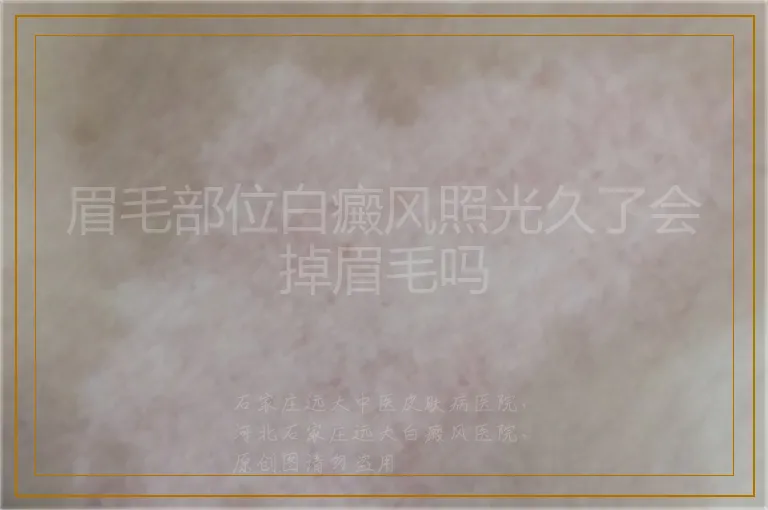 眉毛部位白癜风照光久了会掉眉毛吗